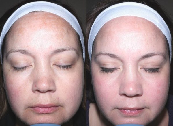 How Often Should I Get Fractional CO2 Laser Skin Resurfacing?