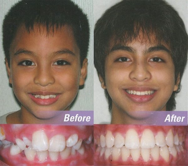 How did orthodontists sell orthodontics?