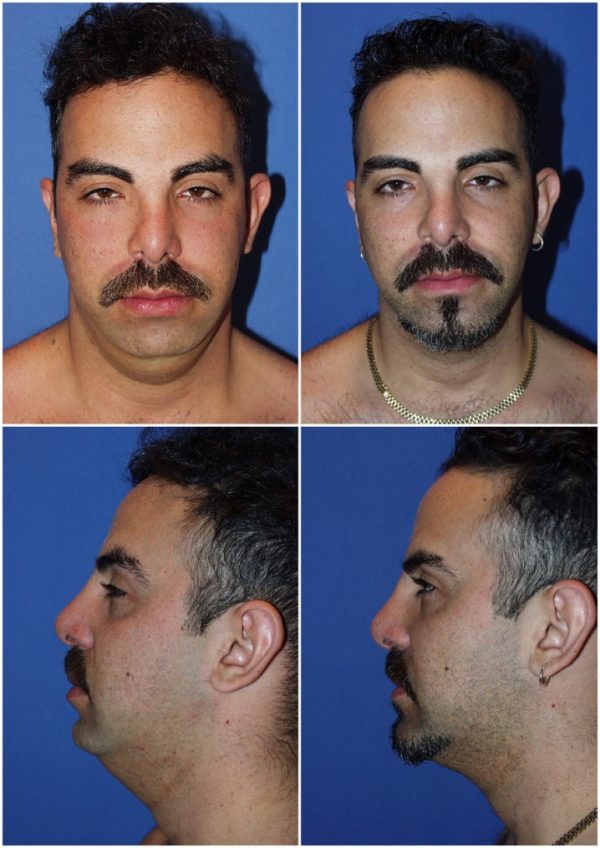 How Many Areas Can I Have Liposuction on at One Time?