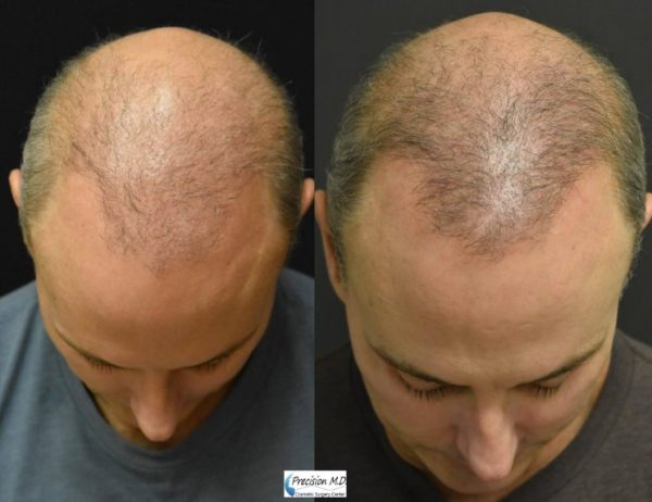 How to Prevent Hair Loss: the Only Things Proven to Cure Baldness